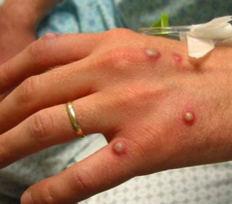 <span style='color:#780948'>ARCHIVED</span> - Monkeypox cases rise to 30 in Spain: the highest in Europe
