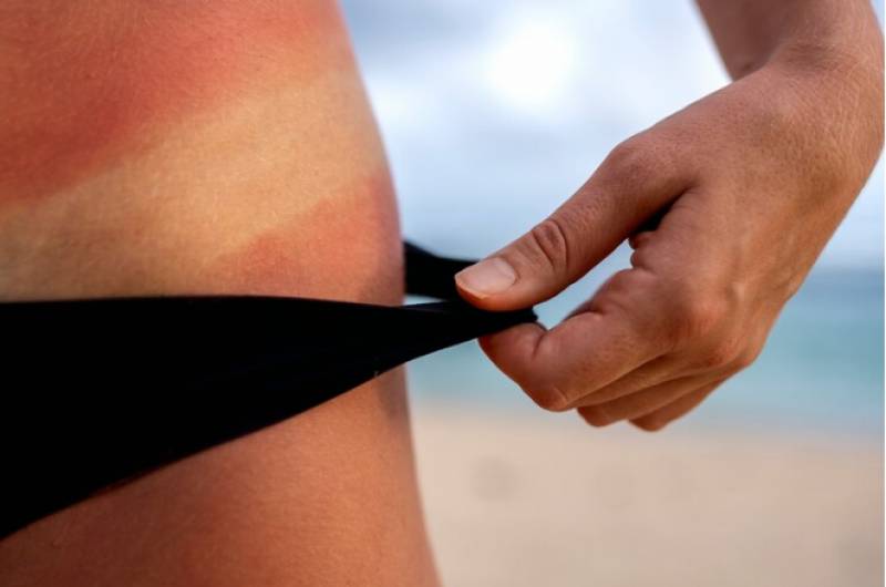 What to do (and what not to do) if you get a sunburn